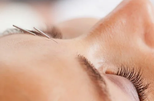 Cosmetic Acupuncture