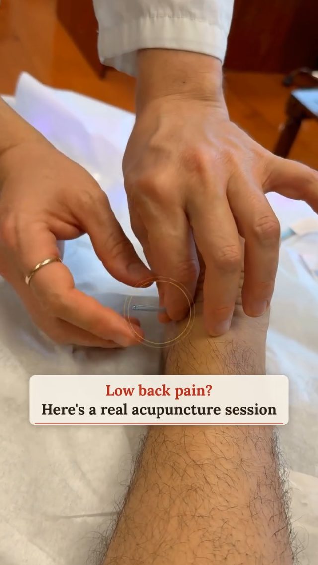Acupuncture for low back pain in Boca Raton.