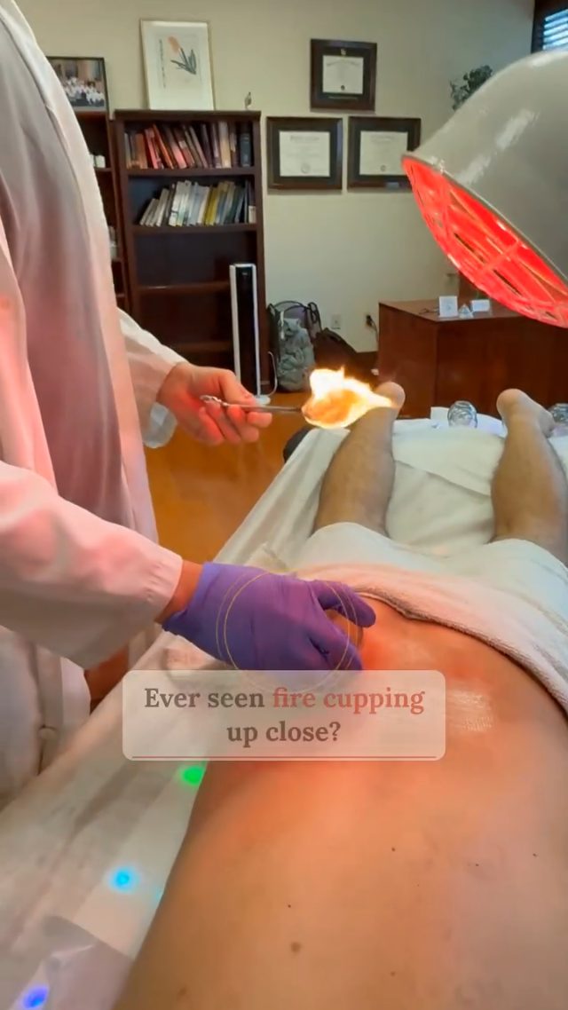Fire cupping for back pain in Boca Raton.